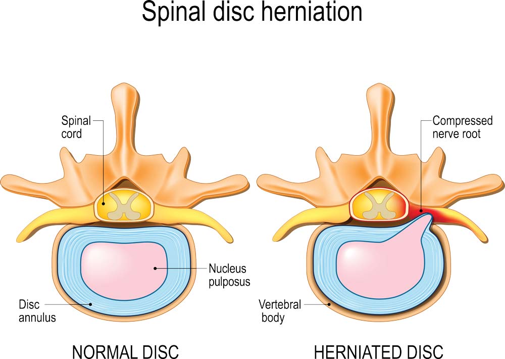 What is a Bulging Disc Injury, and How is it Treated? - Back Pain