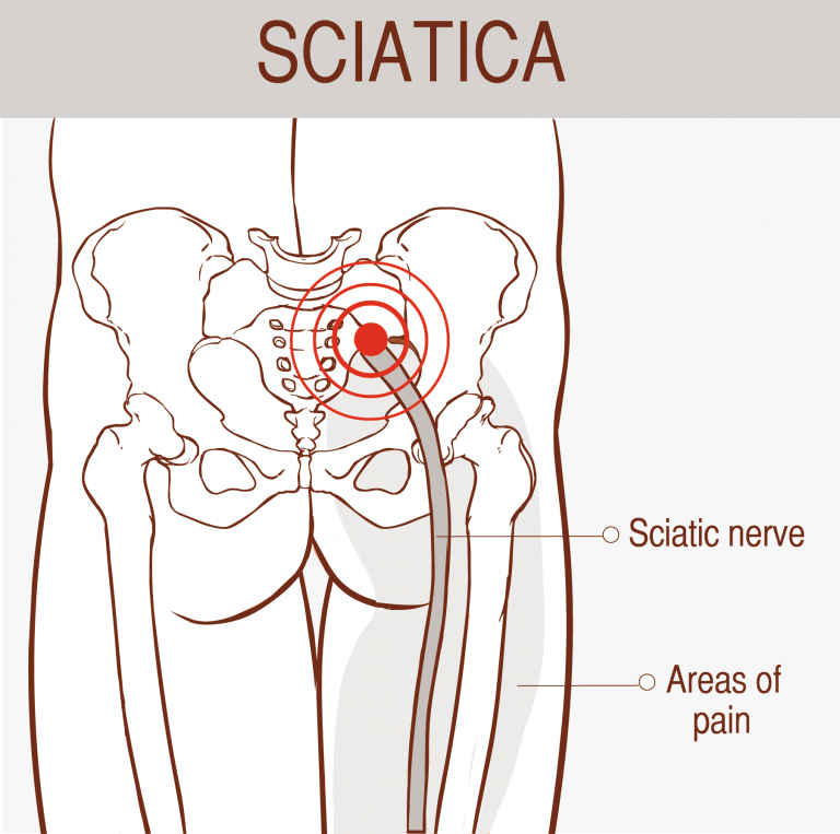 Sciatica Treatment Pain Relief Chiropractor Back Pain Relief Clinic