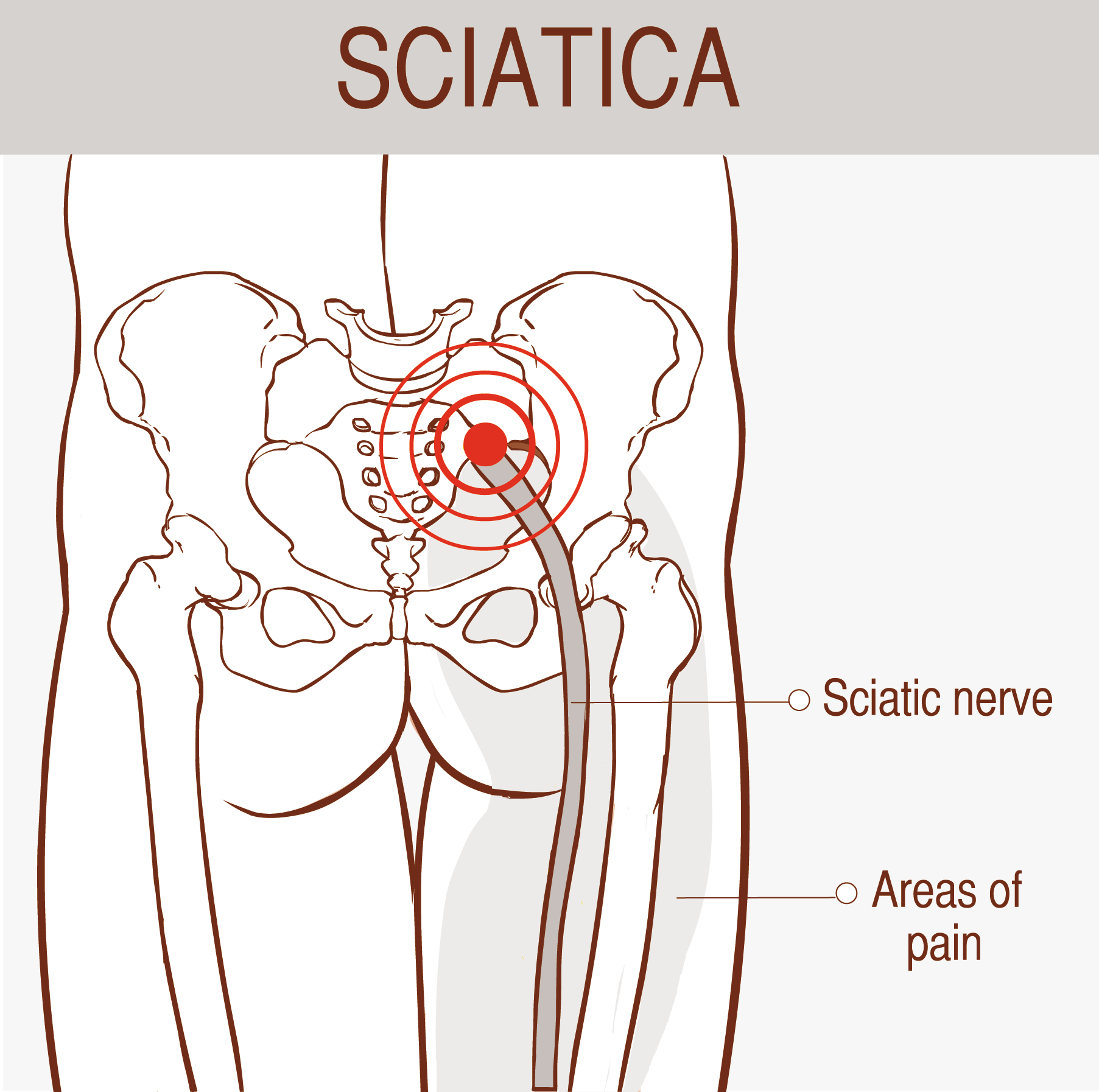 sciatica